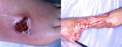 Acd A Z Of Skin Leg Ulcers