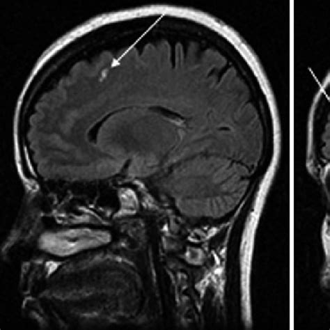 1 Brain Mri Of A Patient With Frequent Migraines Who Had White Matter
