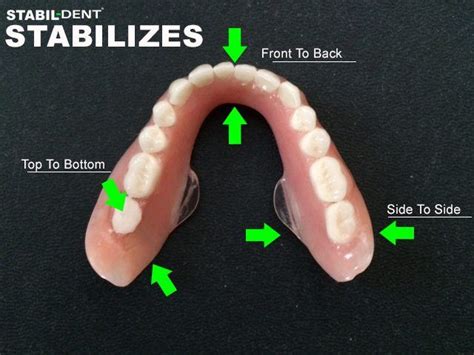 14 best dentures fitting less sorez images on Pinterest | Dental