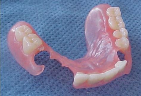 Valplast Partial Denture Partial Dentures Denture Dental World