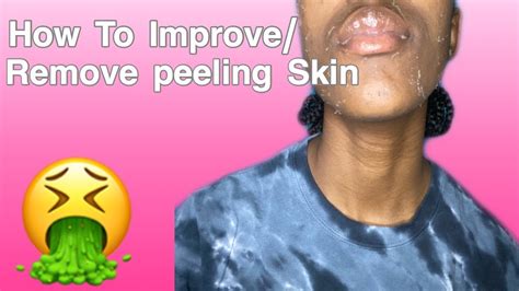 How To Improve Remove Peeling Dry Skin Youtube