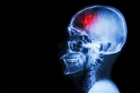 What Is Cte Disease Information Causes Treatment And Prevention