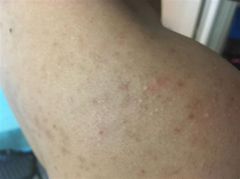 Pin On Skin Infection