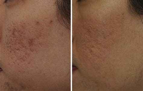 Beautiful Results Of Treatment Of Acne Scars Using Fractionated Co2 Lasers