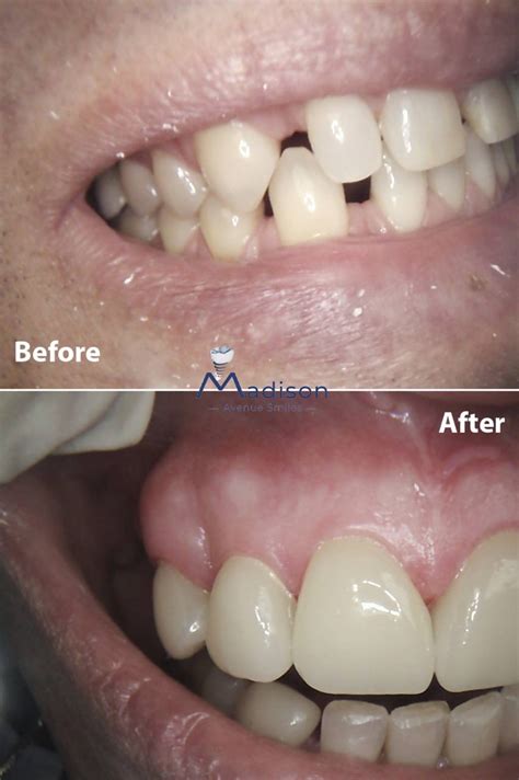 Porcelain Veneers In Nyc Top Quality Veneers In Manhattan