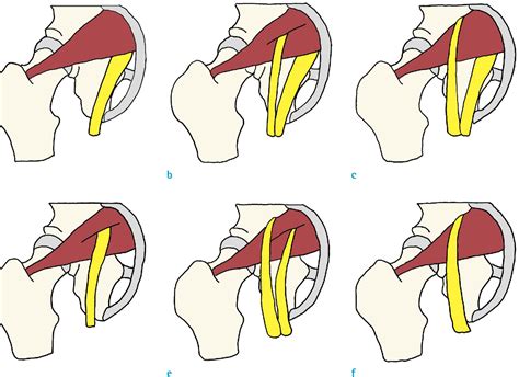 Figure 3 From Accessory Belly Of The Piriformis Muscle As A Cause Of