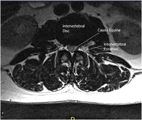 Cauda Equina Mri