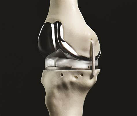 The Future Is Now Christ Hospital Creates D Printed Knee Implants
