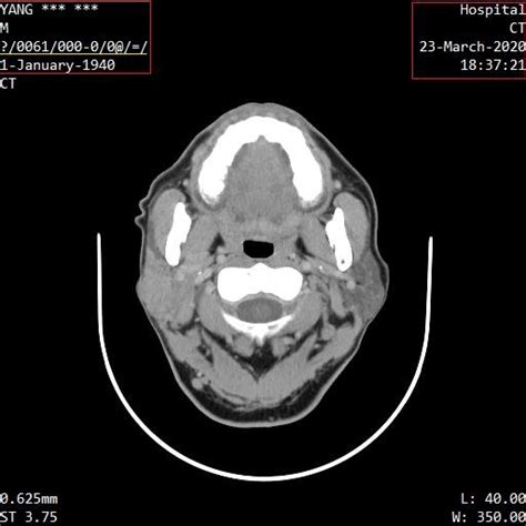 Ct Image Of Parotid Tumor After Desensitization And Encryption