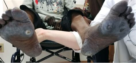 Cureus Hyperpigmentation With Capecitabine Part Of Hand Foot