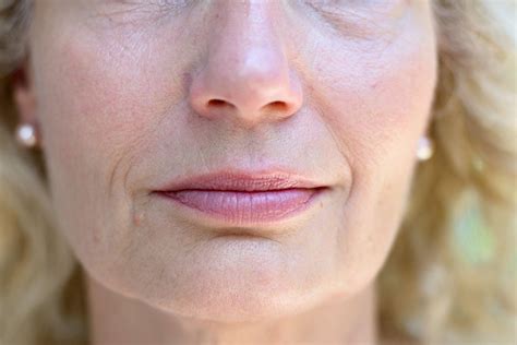 How To Get Rid Of Nose Wrinkles Icbr