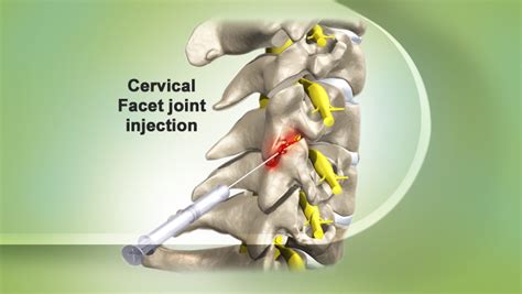 Facet Joint Nerve Block Injection
