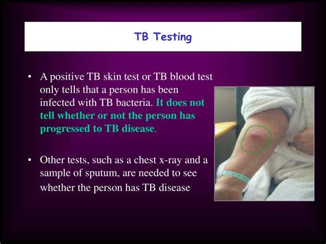 Ppt Tuberculosis 101 James R Ginder Ms Wemtpi Ches Health