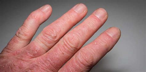 What Are The 5 Types Of Psoriatic Arthritis And How Do They Differ