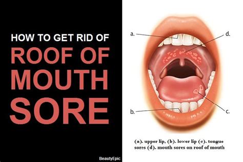 5 Simple Ways To Get Rid Of Roof Of Mouth Sore At Home Roof Of Mouth Sore Mouth Sores