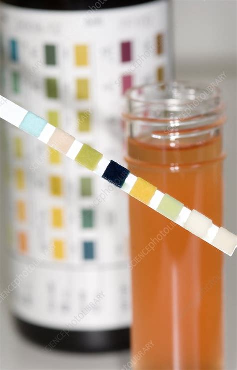 Blood In Urine In Bladder Cancer Stock Image C0041258 Science