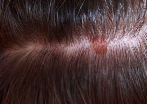 Scalp Bumps Large Bumps On Scalp Red Bumps On My Scalp Itchy Bumps