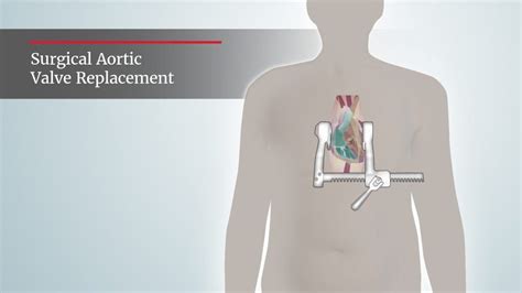 Surgical Aortic Valve Replacement Through Open Heart Surgery Uk