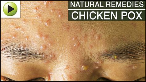 Skin Care Chicken Pox Natural Ayurvedic Home Remedies Youtube