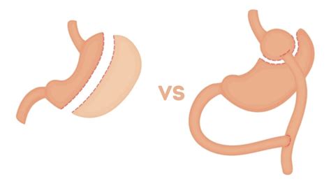 Gastric Sleeve Vs Gastric Bypass Whats The Difference