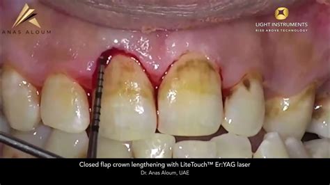 Closed Flap Crown Lengthening With Litetouch™ Eryag Laser Youtube