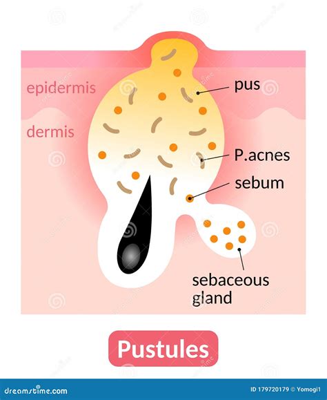 Acne Pustule Is An Inflamed Skin Pore Clogged With Pus Skin Care