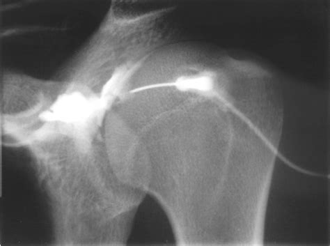 Arthrography Of The Shoulder A Simple Fluoroscopically Guided Approach
