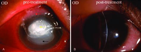 A Diffuse Superficial Conjunctival Congestion Gelatinous Hyperplasia