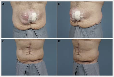 Prospective Repair Of Ventral Hernia Working Group Type 3 And 4