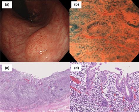 Endocytoscopy For The Diagnosis Of Marginal Zone B‐cell Lymphoma Of