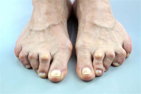 Hammertoe Care And Treatment At Triad Foot And Ankle Center