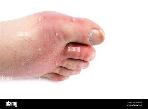 The Swollen Toes And Feet Of An Older Person Suggesting Gout Or A