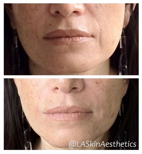 Juvederm Before And After Nasolabial Folds Pin On Non Surgical