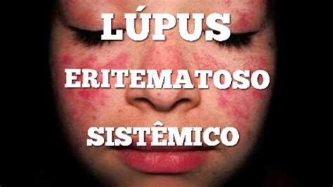 Qsm Caso Da Semana Tudo Sobre Lúpus Eritematoso Sistêmico Youtube