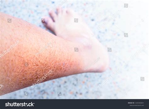 Dry Cracked Skin Ichthyosis Vulgaris Stock Photo 1244303641 Shutterstock