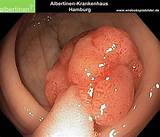 Pictures of Cancerous Polyps In Colon Treatment