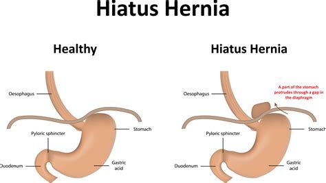 What Size Hiatal Hernia Needs Surgery
