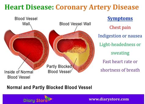 Coronary Heart Disease Definition Examples And Forms