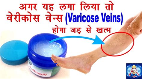 वैरिकोस वेन्स के सबसे असरदार घरेलु इलाज Varicose Veins Natural
