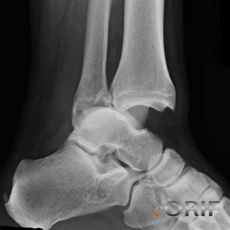 Ankle Dislocation S9306xa 8370 Eorif