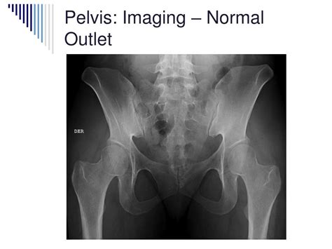 Ppt X Rays Pelvis Hip And Shoulder Powerpoint Presentation Free