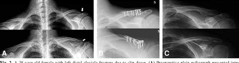 Figure 2 From Operative Treatment Of Distal Clavicle Fracture With