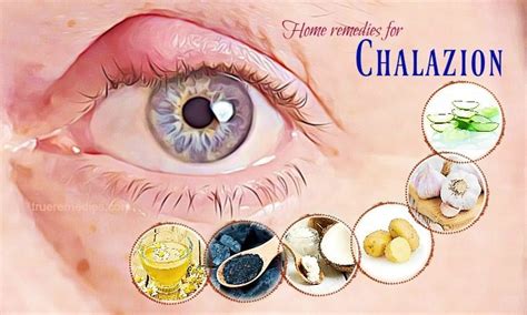 38 Natural Home Remedies For Chalazion Cysts On The Eyelid