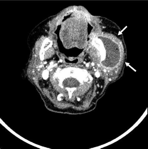 Ct Scan Image Showing Abscess Formation Over The Left Ramus Mandibulae