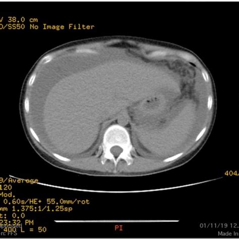 Abdominal Ct Scan Showed Thickening Of Stomach Wall With Widely