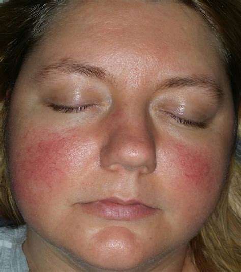 Is It Rosacea Rosacea And Facial Redness By Trishmariep Community