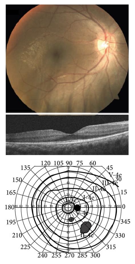 Fundus Photographs Optical Coherence Tomography Oct Images And