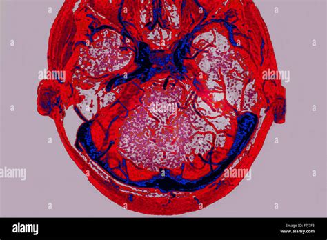Cerebral Venous Thrombosis Stock Photo Alamy