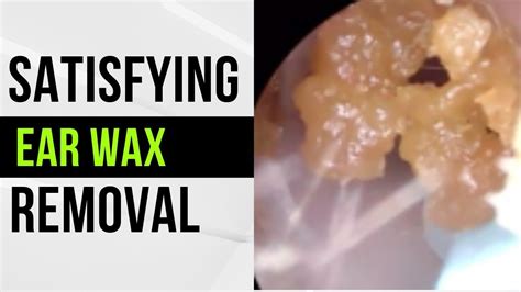 Satisfying Ear Wax Removal Youtube