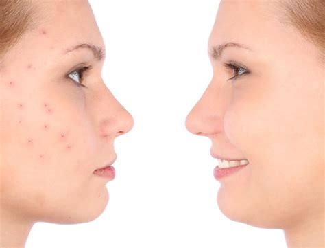 What Treatments Are Best For Active Acne Guilford Active Acne